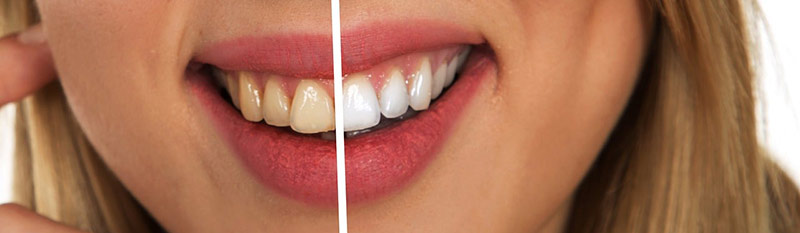 ZahnFIX bringt dich wieder zum Lachen